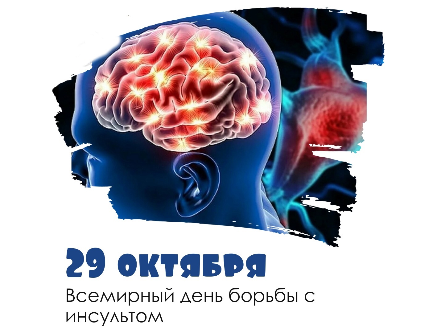 Вместе против инсульта.